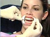 Perfect Smile ZOOM tooth whitening